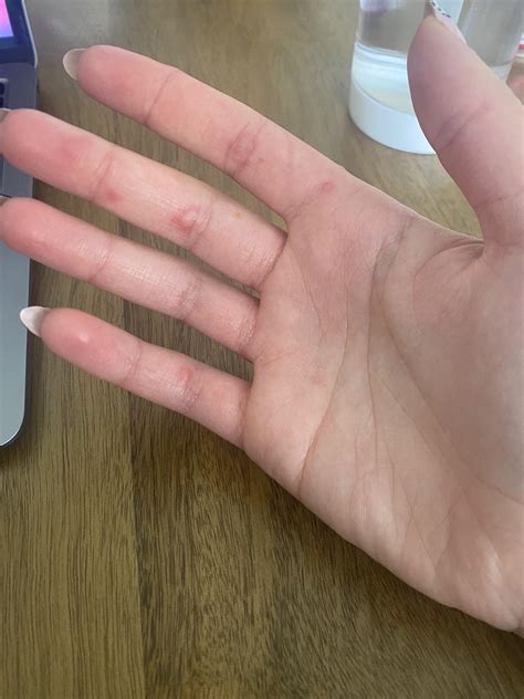 I have these painful, itchy blisters all over my hands. Could it be