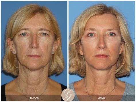 Deep Plane Facelift Explained