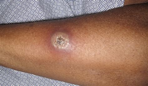 Pyoderma Gangrenosum Ulcerative Colitis