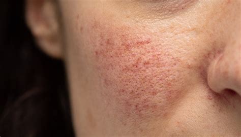 How To Treat Rosacea - Causes, Symptoms, Types – SkinKraft