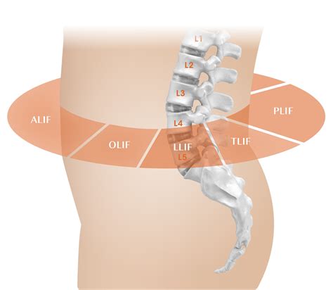 Lumbar Spine Patient Education — Camber Spine Med Tech 