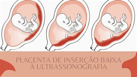 Placenta Baixa O Que Fazer Para Subir - Placenta de Inserção Baixa à Ultrassografia - YouTube