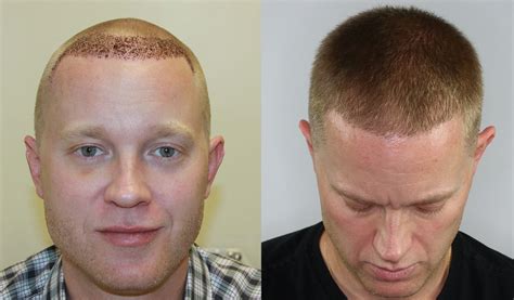 Hair Transplant Buzz Cut at Elizabeth Neace blog