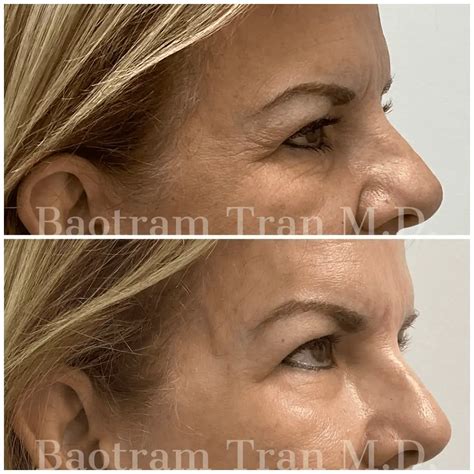 facial thread lift archives tran plastic surgery