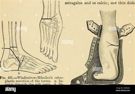 operative surgery ions  bones    recoveries