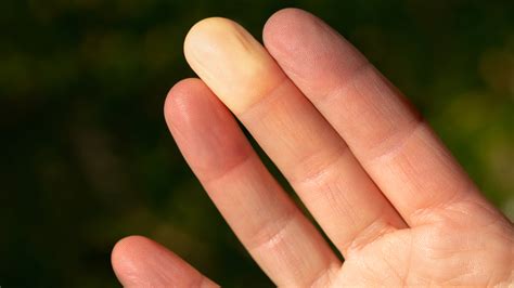 raynauds syndrome treatment  pictures goodrx