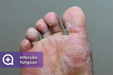 O Que É Micoses De Pele