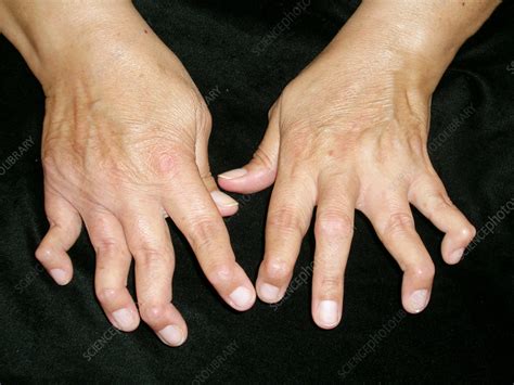 swan neck deformity  rheumatoid arthritis stock image