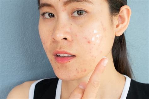 manage  acne    experts
