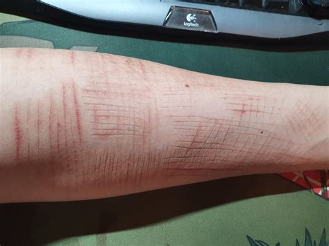 My left forearm. 2 weeks clean. : r/SelfHarmScars