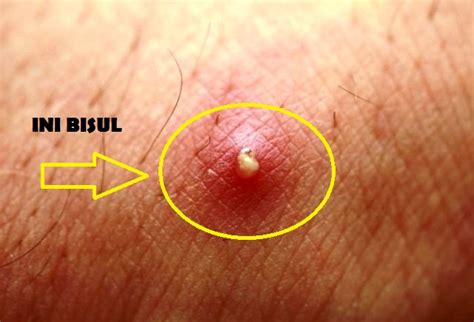 mengobati bisul secara alami  cepat pecah manfaatcaranyacom