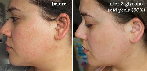 glycolic acid