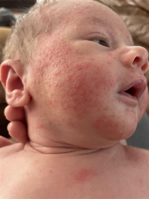 newborn face rash cream 1