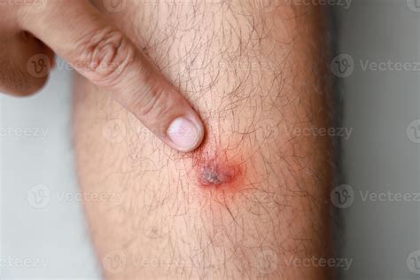 A man verruca vulgaris his leg. Causes of Symptoms of Human Papilloma