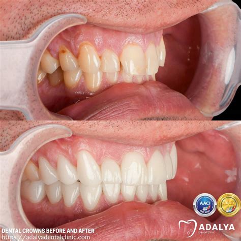 dental crowns    adalya dental clinic