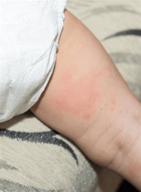 Common Baby Rashes & Skin Conditions | Thomson Medical