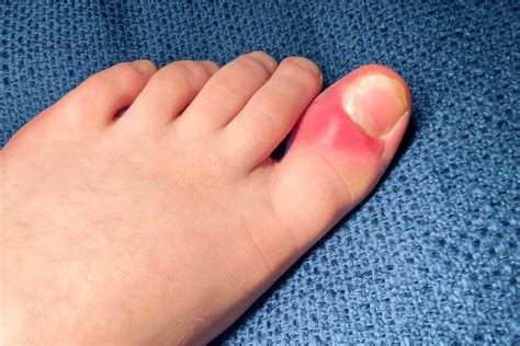 Overcoming Toe Pain: Julie’s Toe Pain Experience - Well Heeled Podiatry