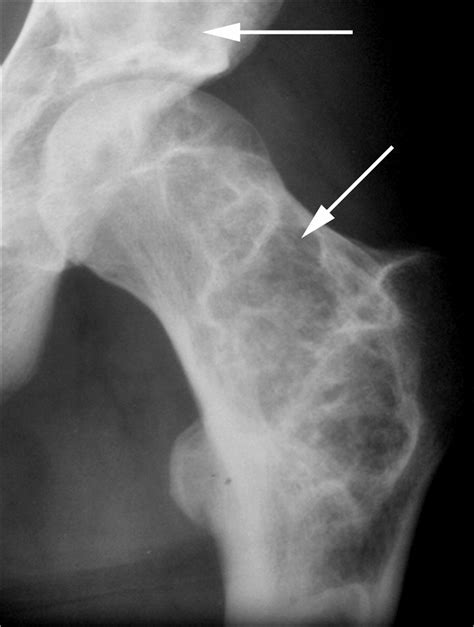 fibrous dysplasia  mccunealbright syndrome imaging  positive