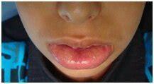 Persistent lower lip swelling Figure 3: A polyp on the lower labial ...