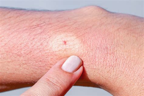 bee sting pictures    bee sting