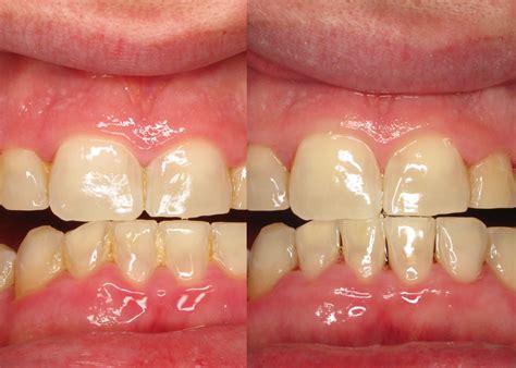 Laser Gum Surgery - Advanced Periodontics & Implant Dentistry