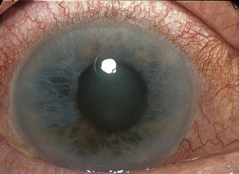 Acute angle-closure glaucoma - American Academy of Ophthalmology