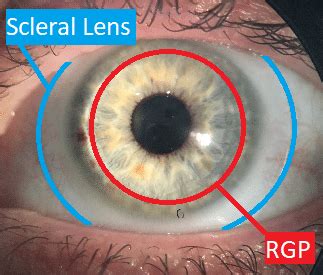 scleral lenses  complex corneas simpson optometry