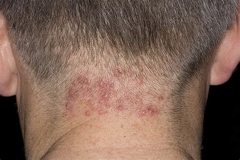 Pityrosporum Folliculitis Scalp - vrogue.co