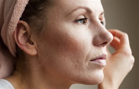 What Causes Broken Capillaries on the Face?