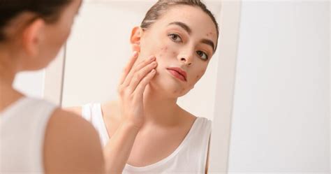 acne  polycystic ovary syndrome hormone  skin care treatment