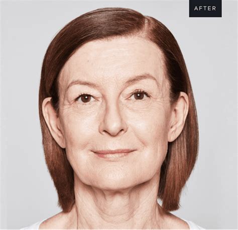 Sculptra UK Cosmetic Facelift - Flawless Aesthetic Clinic