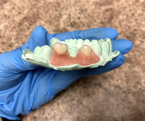 Diy Denture Kit Instructions / Mark It Denture Marking Kit Mountainside ...