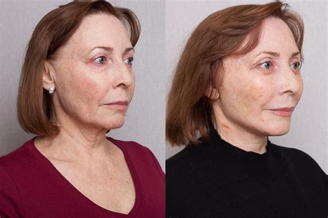 Фото До И После Подтяжки Кожи — New-Freepik.Ru