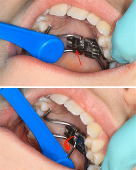 RPE Rapid Palatal Expander — Tri-Valley Orthodontics