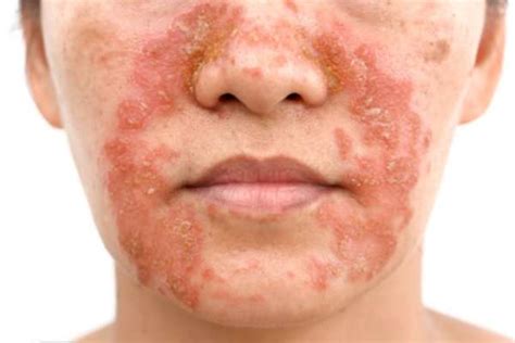 Homeopathy Specialist For Treatment Of Eczema On Face In Mumbai, Surat