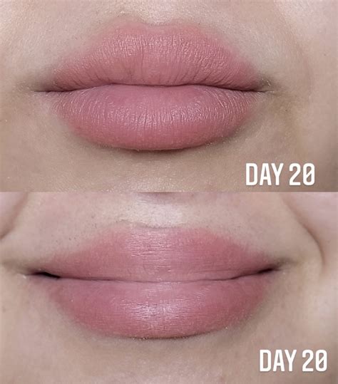 how to remove fordyce spots 1