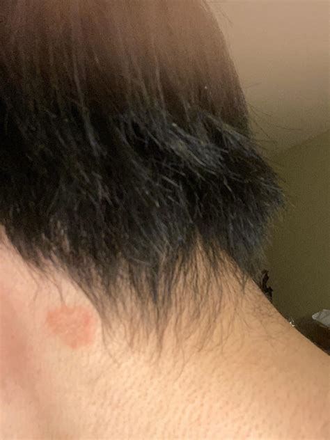 Is this ringworm? : r/ringworm