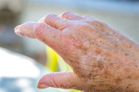 Altersflecken Haut - Bilder und Stockfotos - iStock