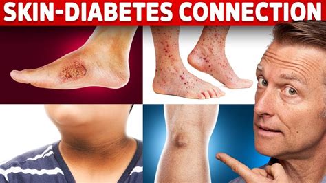 Diabetic Rash On Shins
