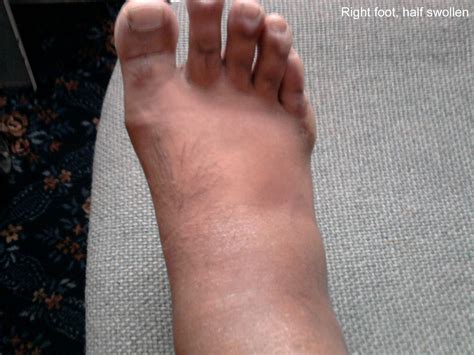 Right foot, half swollen | Gout Sufferer