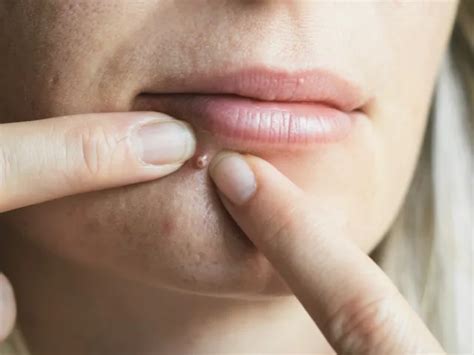 Should You Pop a Pimple or Leave It Alone? | HUM Nutrition Blog