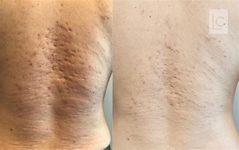 Laser Co2 Cicatriz Antes E Depois - Cicatrizes De Acne Antes E Depois Com Laser De Co2 Confira