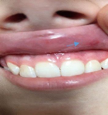 aphthae   child diagnosed  crohns disease