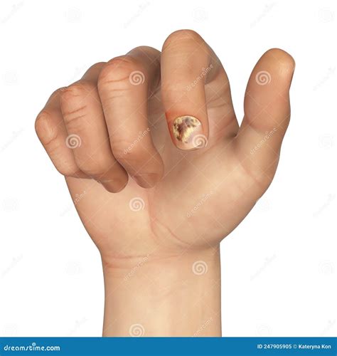 Dermatophytosis. Human Skin With Ringworm Vector Illustration