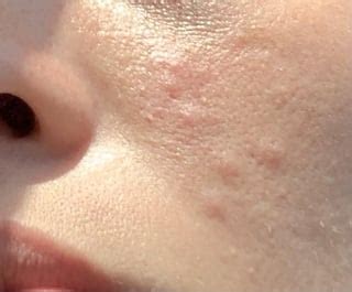 Please Help. Skin Rash on face? : r/skin