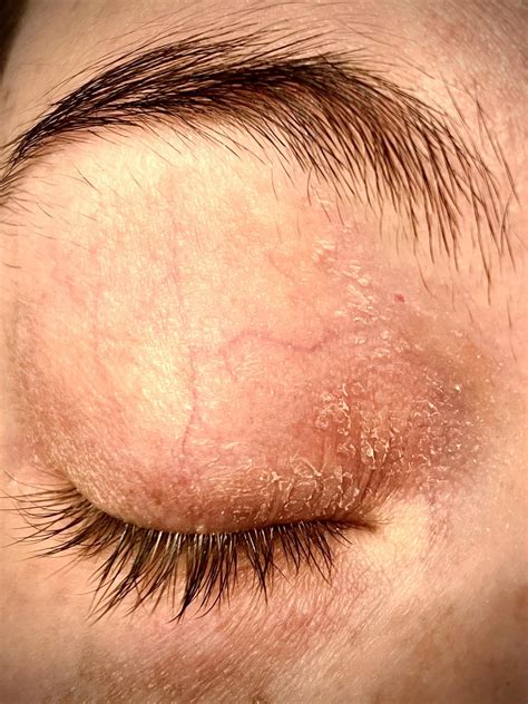 Eyelid Dermatitis Eyelid Dermatitis (xeroderma Of The Eyelids, Eczema