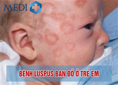 Bệnh lupus ban đỏ hệ thống là gì? Bệnh có nguy hiểm không?