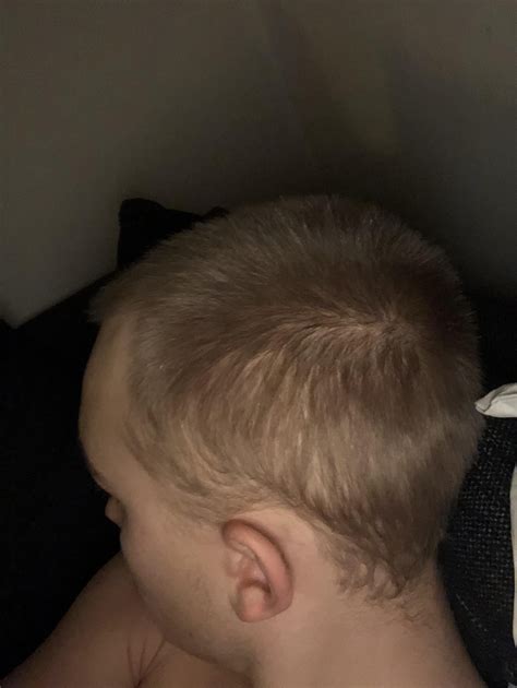Diffuse thinning on scalp and sides since 13 whit a burning/tingling