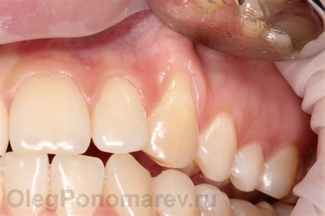Почему оголяются шейки зубов? О рецессиях десны... | PerfectSmile