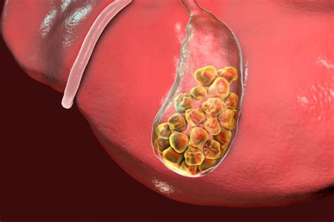 Angiodysplasia Symptoms – News185